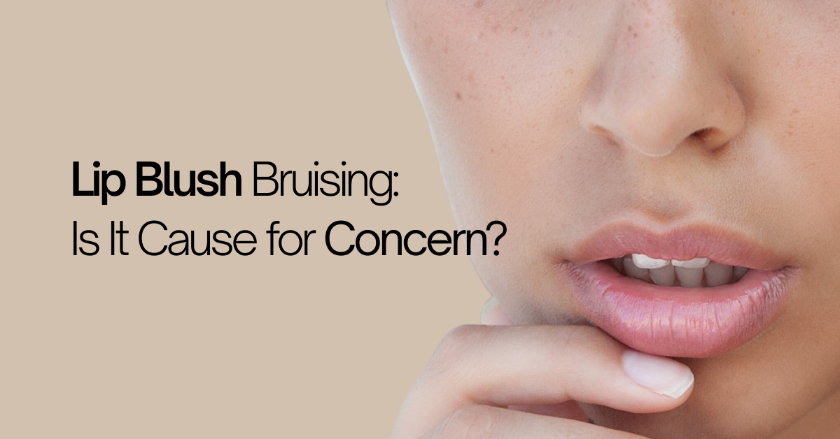 Bruising After Lip Blush – Is It Normal & How to Manage It?